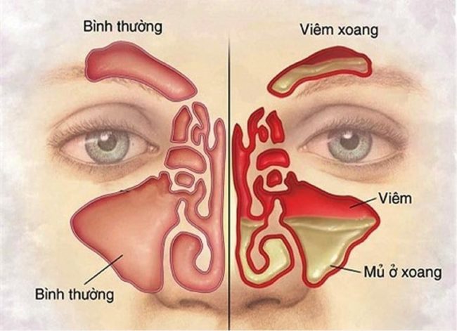 nguyen nhan dau hieu va cach dieu tri benh viem da xoang 4f5 5271178