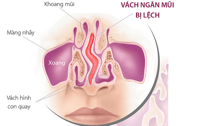 nhung dieu ban can biet ve benh viem xoang tran d78 5270109