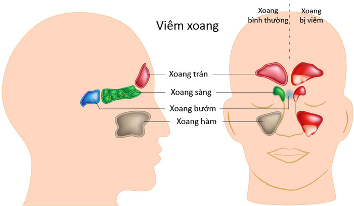 tong hop cac phan loai viem xoang thuong gap 9b9 5271190