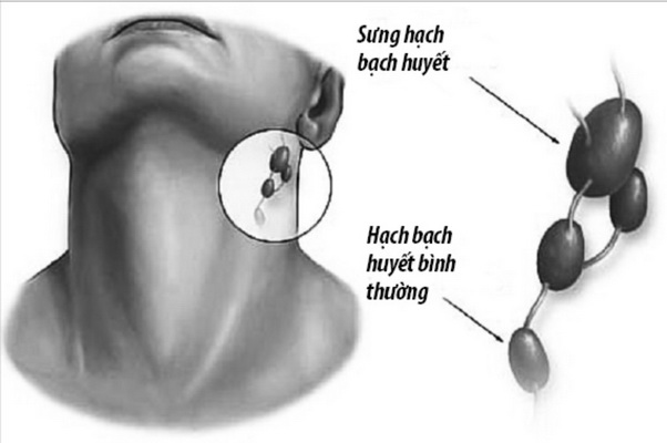 Bệnh lao hạch có lây không? - Hình 1