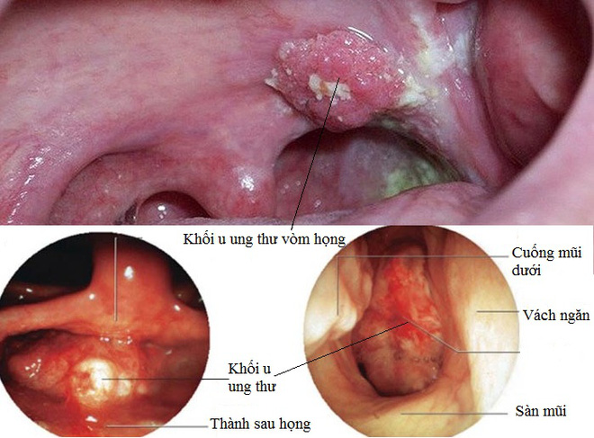 ung thu vom hong hay bi nham voi cam cum bs nhac co dau hieu nay 1 tuan khong khoi thi phai kham 87f 5380535