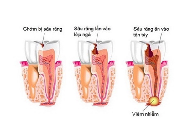 de phong bien chung viem xuong tuy ham 33b 5392359