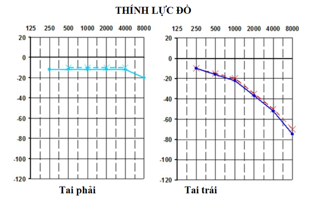 chong mat nghe kem phat hien u trong nao 8a0 5350480