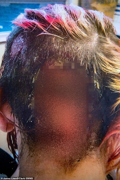 Nhuộm tóc có rủi ro và có thể gây nguy hiểm nếu không thực hiện đúng cách. Nhưng bạn không phải lo lắng khi xem hình ảnh này về một trường hợp nhuộm tóc suýt chết để biết được những nguy hiểm cần tránh.