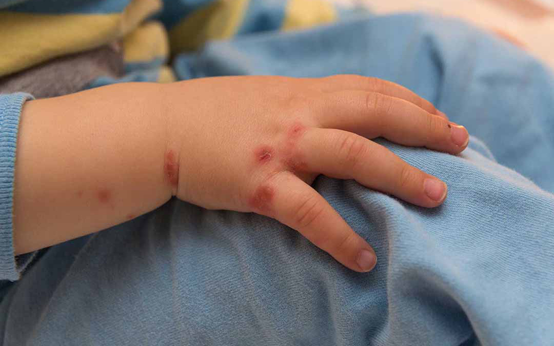 Những nguyên tắc cách ly khi bị tay chân miệng có thể bạn chưa biết - Hình 1