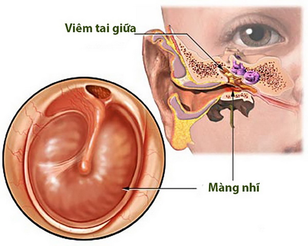 bai thuoc tri viem tai giua 90c 5468145