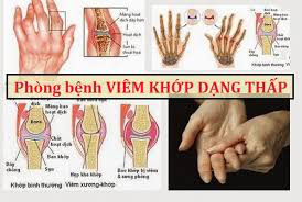 nhung loi khuyen day du cho nguoi bi viem khop dang thap tu an uong den van dong va thuoc ef9 4787583