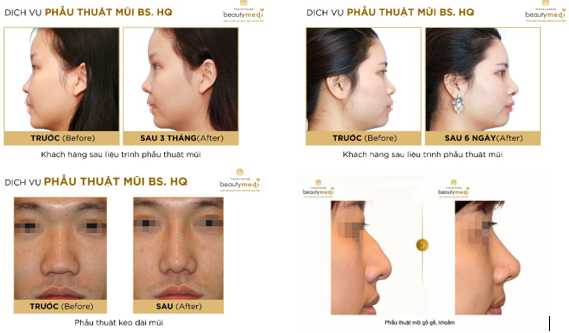 Thay đổi dáng mũi - thay đổi vận mệnh - Hình 3