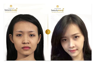 Thay đổi dáng mũi - thay đổi vận mệnh - Hình 2