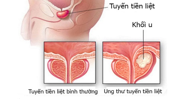 dieu tri ung thu tuyen tien liet nhu the nao d19 4731982