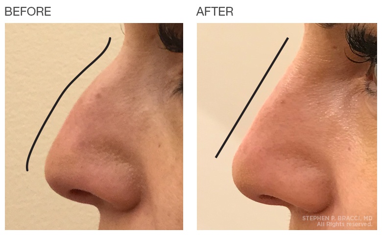 5 sự thật về cách nâng mũi không cần phẫu thuật - Hình 1