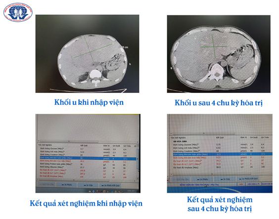 ung thu di can khong con la an tu 91d 5108125