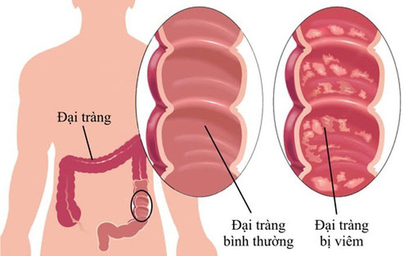 Mách bạn 2 món ăn tốt cho người bị viêm đại tràng - Hình 1
