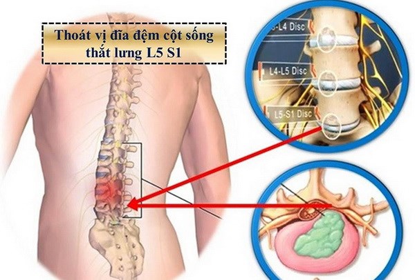 bai thuoc dong y va cach xoa bop chua dau lung 117 5489290