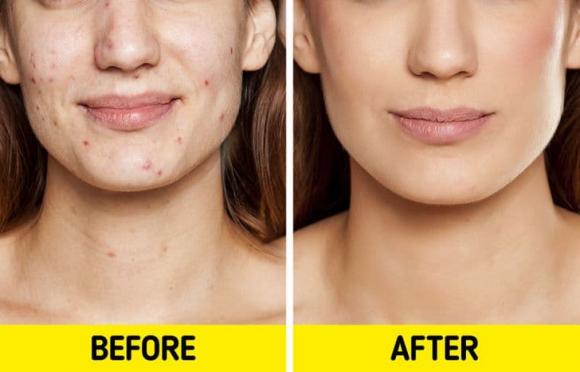 5 cách tự nhiên để thoát khỏi mụn và bí quyết giúp da luôn mịn màng, tươi trẻ - Hình 3