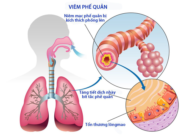 mon an bai thuoc tri viem phe quan tai phat trong mua dong fc9 6152245