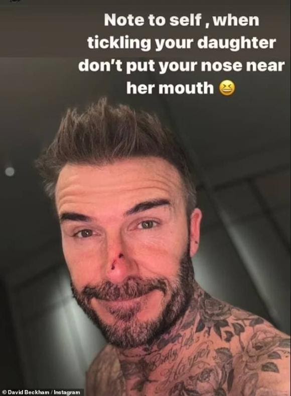 David Beckham gây sốc khi xuất hiện với vết thương lớn ở mũi hậu khẩu chiến với Victoria - Hình 1