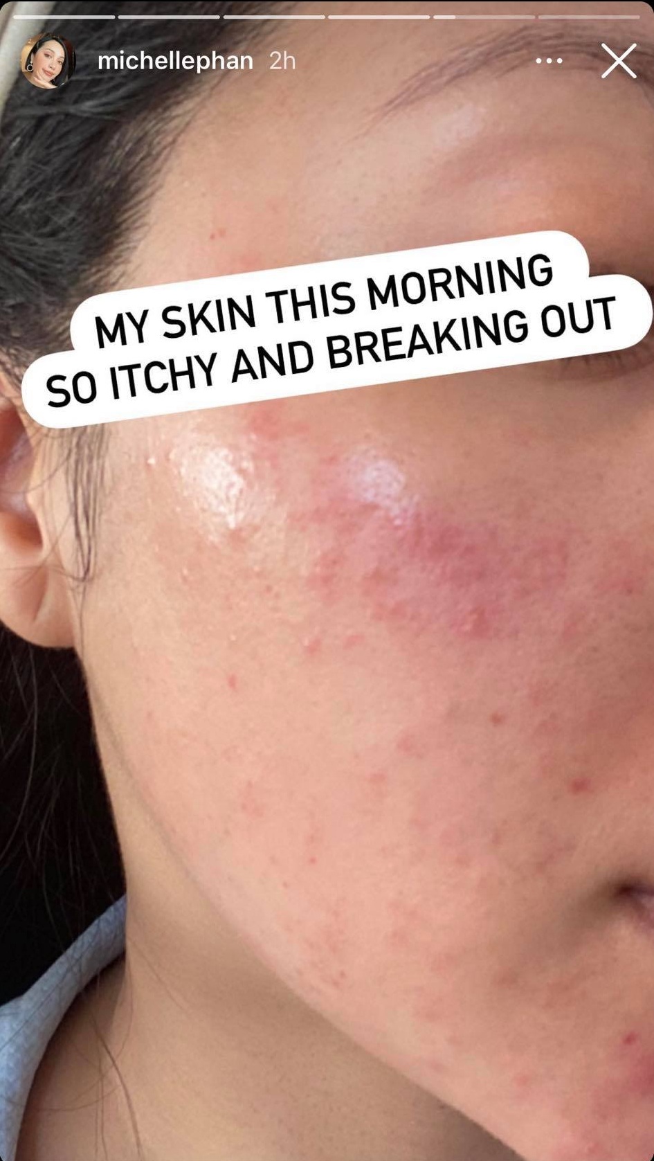 Gần Tết còn đi làm laser, chị em đừng dại mà khéo lại nhận cái kết đắng như Michelle Phan - Hình 6