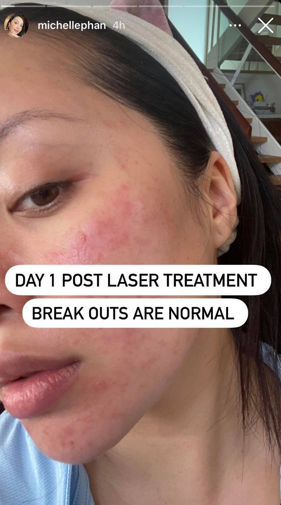 Gần Tết còn đi làm laser, chị em đừng dại mà khéo lại nhận cái kết đắng như Michelle Phan - Hình 2
