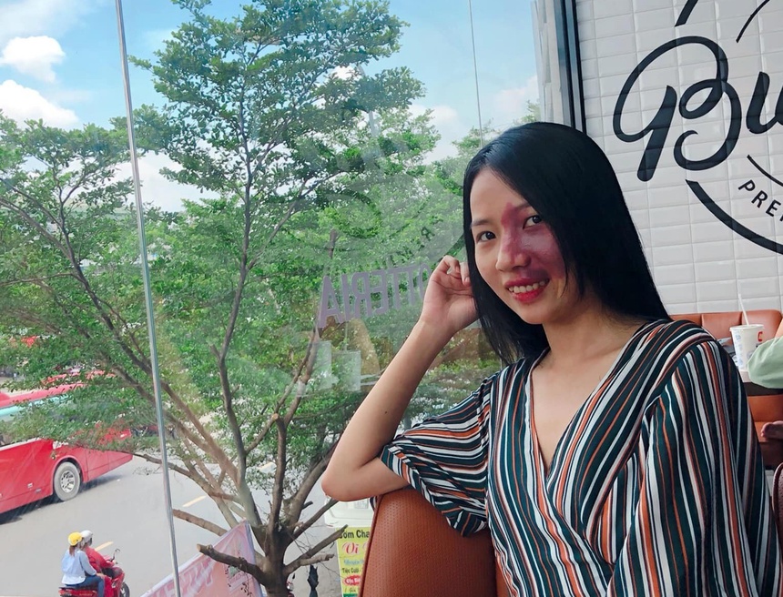 Vết bớt trên mặt là món quà của cha mẹ - Hình 4
