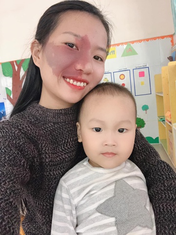 Vết bớt trên mặt là món quà của cha mẹ - Hình 3
