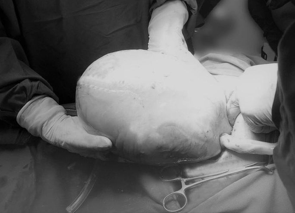 Song thai chào đời, một bé còn nằm trong bọc ối