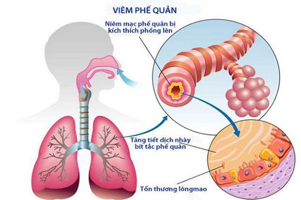 canh giac bien chung cua viem phe quan cap 53f 5621974