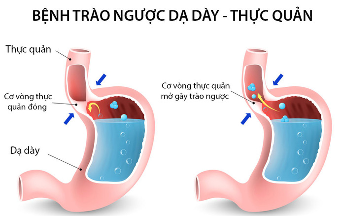 nhieu nguoi nham lan hoi chung trao nguoc thuc quan da day voi viem hong ddd 5719761