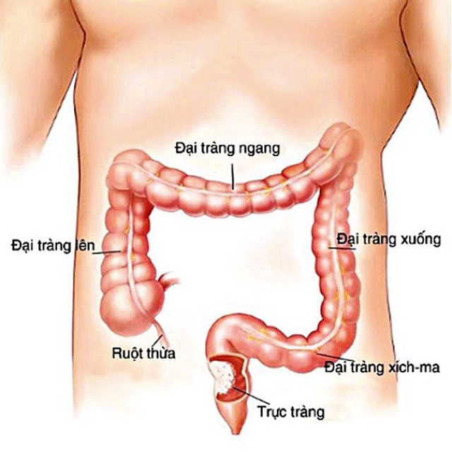 Đi ngoài ra m.áu, người phụ nữ đi khám phát hiện ung thư thể hiếm gặp