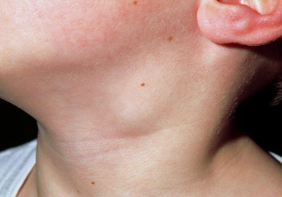 Dấu hiệu nhận biết Rubella giai đoạn phát bệnh - Hình 3