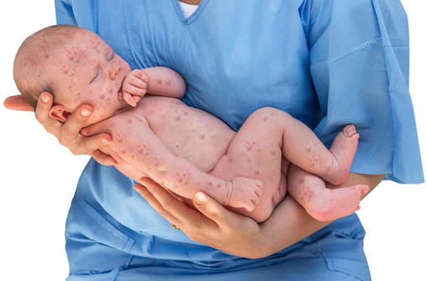 Dấu hiệu nhận biết Rubella giai đoạn phát bệnh - Hình 4
