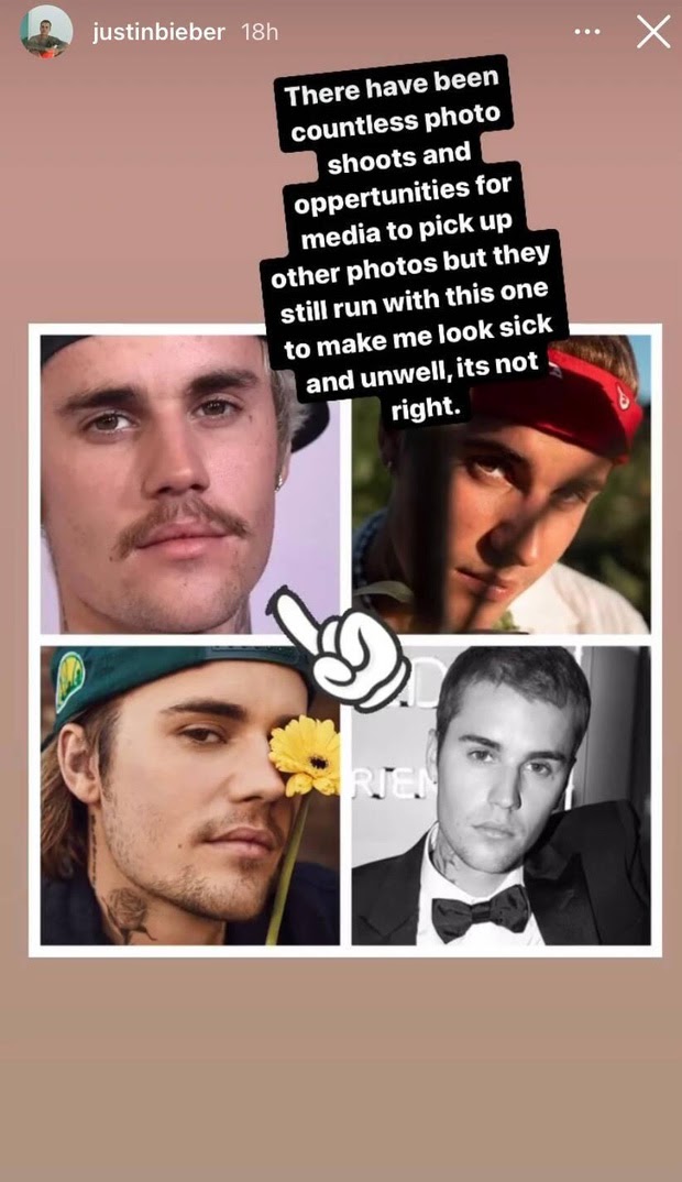 Justin Bieber mắc bệnh hiếm gặp dẫn đến xuống sắc không phanh - Hình 2