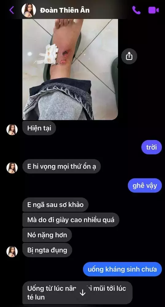 Thiên Ân gặp tai nạn giao thông chân thâm đen, sưng vù, sức khỏe đáng báo động tại MGI? - Hình 5