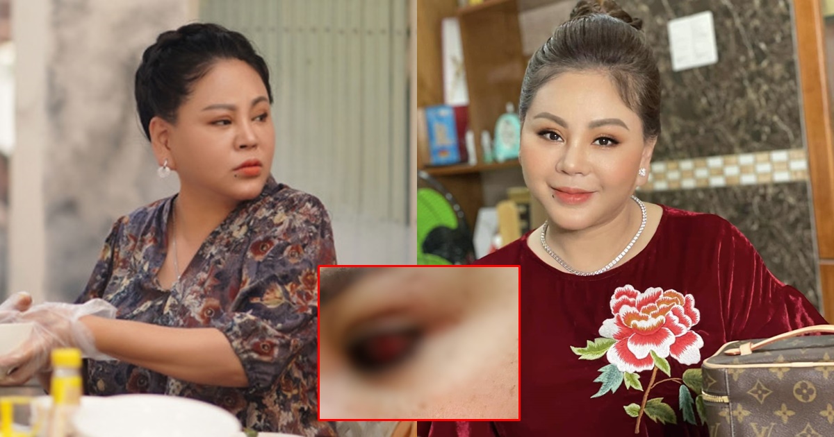 NS Lê Giang gặp tai nạn nghiêm trọng bị rách giác mạc, dàn sao Việt lo sốt vó khuyên nhập viện? - Hình 9
