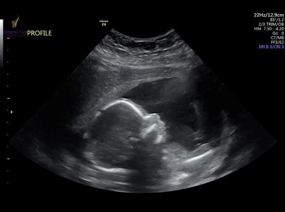 Hãy xem hình ảnh siêu âm của em bé để chứng kiến sự phát triển nhanh chóng của bé yêu trong bụng mẹ nhé.