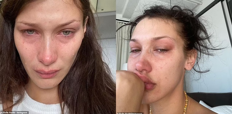 Siêu mẫu Bella Hadid gây sốc khi dao kéo từ năm 14 tuổi, từng bị trầm cảm tới mức ngủ dậy là khóc - Hình 3