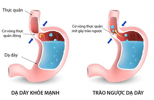 trao nguoc da day thuc quan nguyen nhan trieu chung va dieu tri 978 6464482