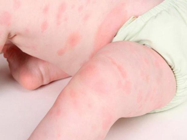 Dùng thuốc nào khi bị dị ứng thức ăn? - Hình 3