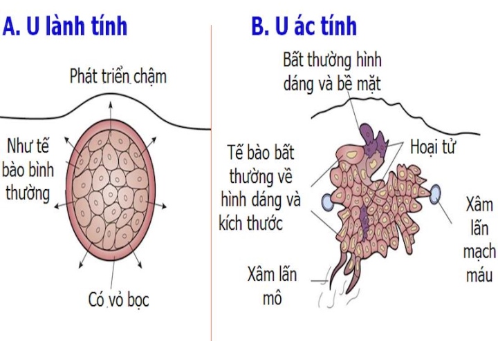 thuoc long nhung bieu hien cua khoi u ac tinh nay de di kham ngay keo muon 761 6593648