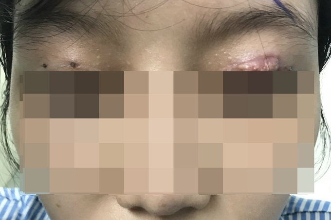 Đi cắt mí tại thẩm mỹ viện, người phụ nữ thủng 4 lỗ ở mắt, vỡ thủy tinh thể - Hình 1