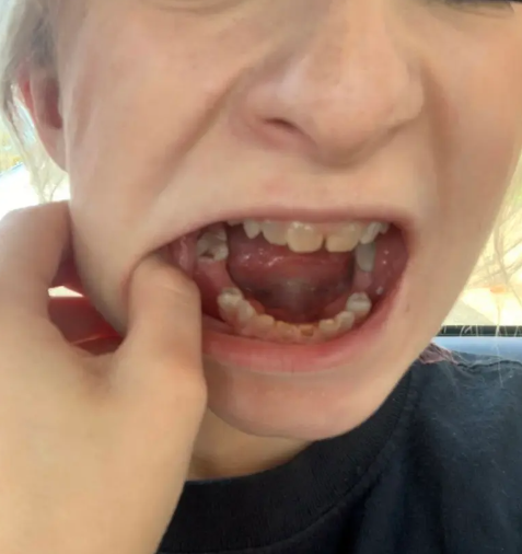 Kỳ lạ cô gái có hàm răng trong suốt, bị gọi là hàm răng cá mập - Hình 2