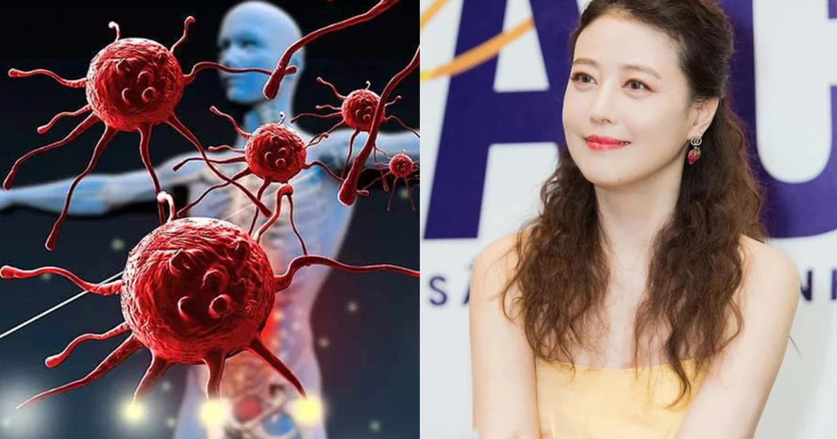 lupus ban đỏ: Căn bệnh mà nữ minh tinh Châu Hải My mắc phải trước khi qua đời nguy hiểm thế nào? - Hình 6
