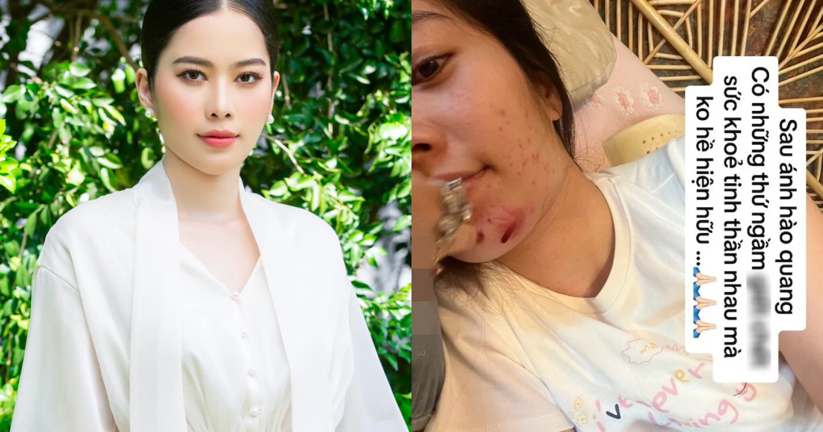 Nam Em lộ gương mặt đầy vết bầm, tiều tụy khó nhận ra, sức khỏe càng đáng báo động hậu ồn ào - Hình 8