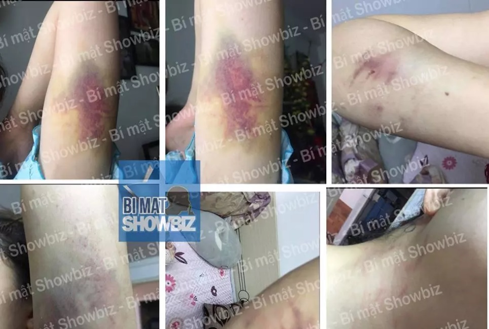 Bảo Trân: Ca sĩ từng vạch mặt Nam Em giật bồ, tố người yêu đánh bầm dập sau mâu thuẫn hiện ra sao? - Hình 6