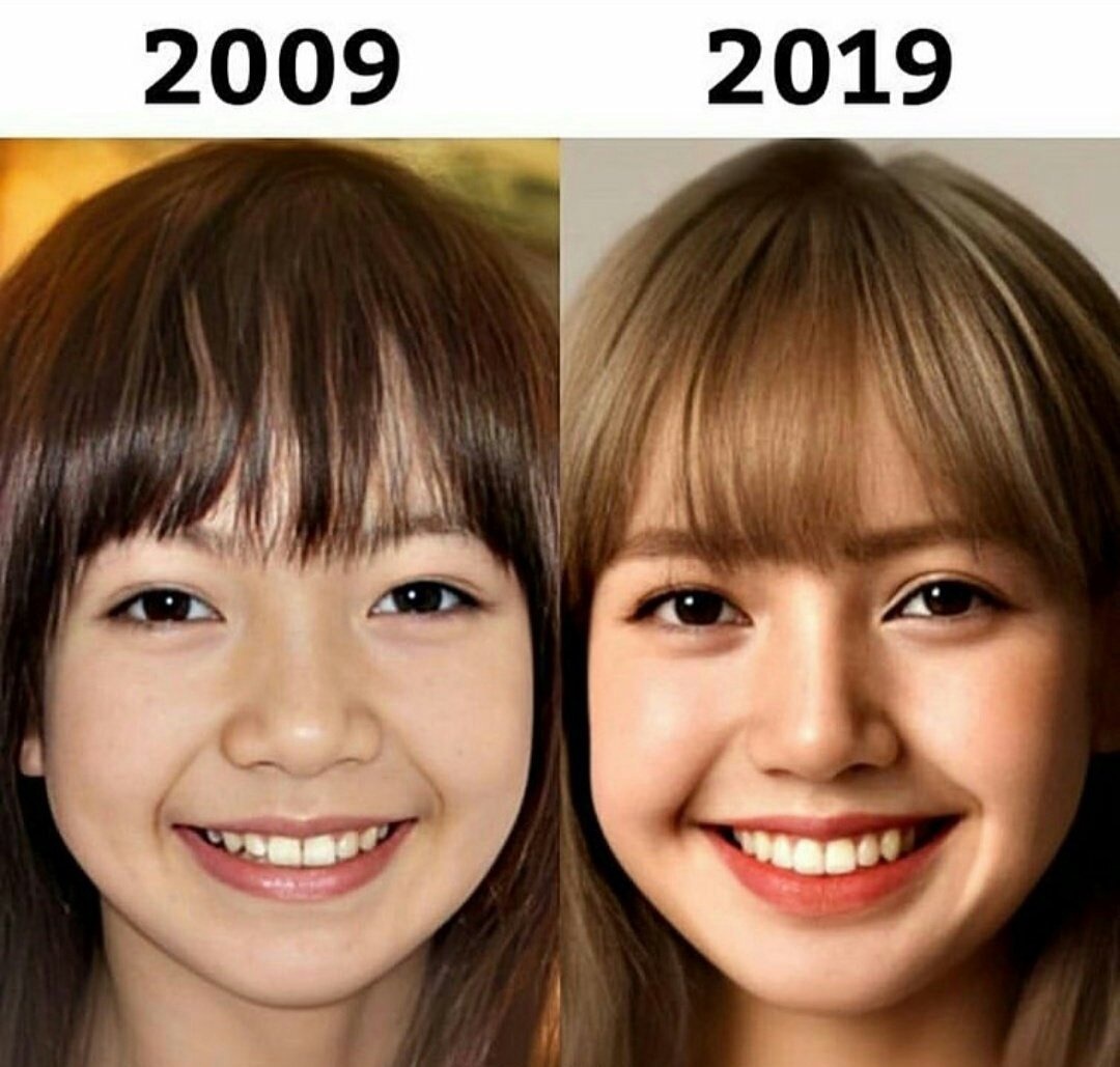 BLACKPINK bị bác sĩ bóc trần chuyện phẫu thuật thẩm mỹ: Lisa sửa gần hết, Rosé tốn hơn nửa tỷ - Hình 6