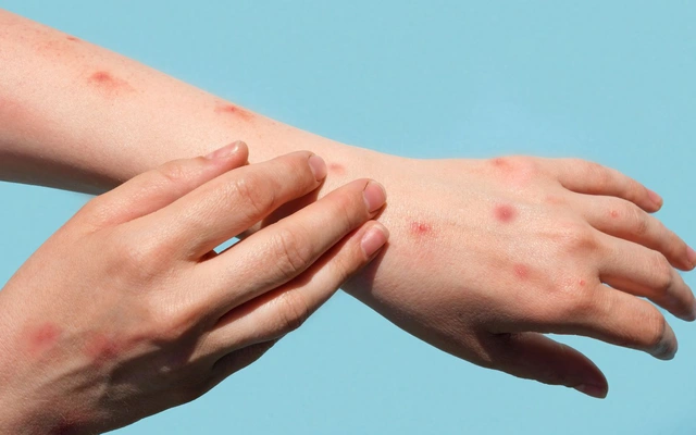 TP.HCM: Bộ Y tế đề nghị xác định nguồn lây 2 ca mắc đậu mùa khỉ, người dân sống trong nỗi lo mới - Hình 1