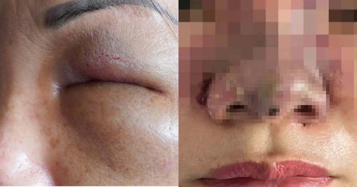 Ham làm đẹp giá rẻ, 2 phụ nữ bị tai biến, lột sạch tài sản sau khi tiêm filler chui ở nhà nghỉ - Hình 6