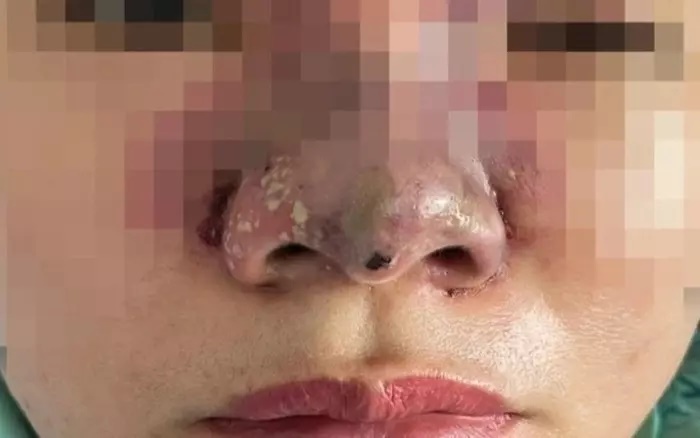Ham làm đẹp giá rẻ, 2 phụ nữ bị tai biến, lột sạch tài sản sau khi tiêm filler chui ở nhà nghỉ - Hình 2