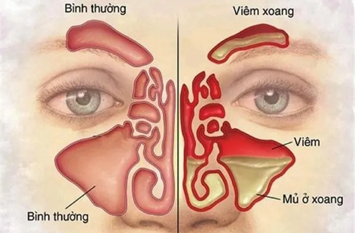 viem xoang co gay dau hoc mat a4d 7088574