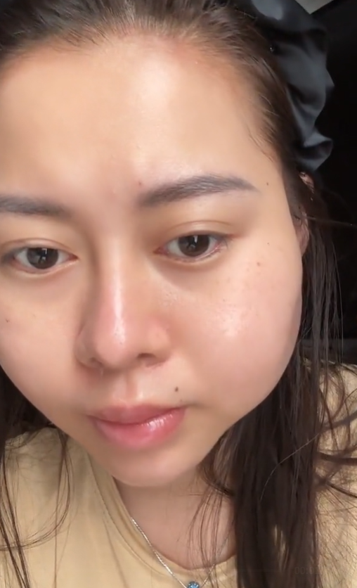 Mặt Việt Phương Thoa biến dạng vì tiêm filler bị tráo sang silicon, phải mổ gấp - Hình 1